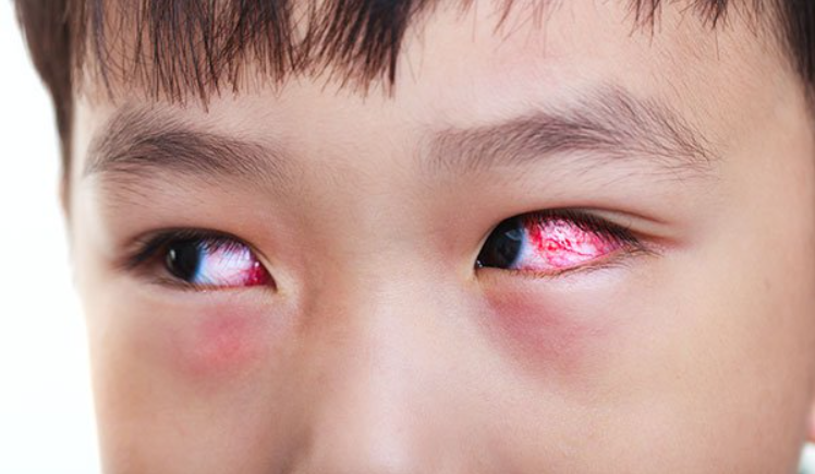 Phòng tránh bệnh đau mắt đỏ khi trẻ đến trường - Ảnh 1